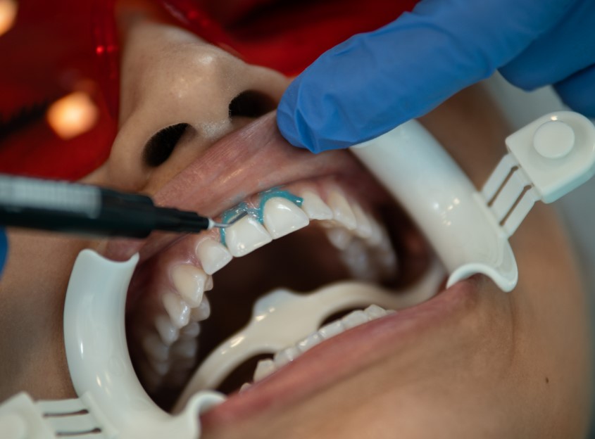 Ajustement d'un appareil orthodontique en bouche