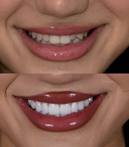Avant-après de facettes dentaires alignant le sourire