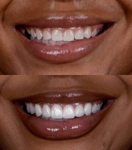 Avant-après d'une transformation du sourire