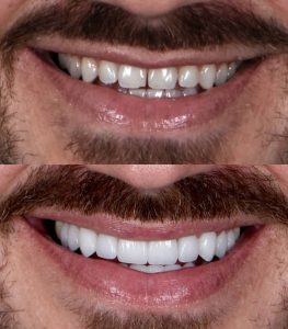 Avant-après du sourire d'un homme après facettes dentaires