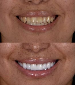 Avant-après du sourire d'un patient après facettes dentaires