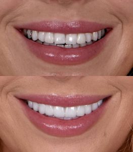 Avant-après du sourire d'une patiente après facettes