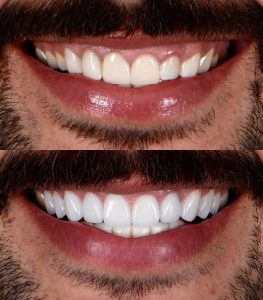 Avant-après du sourire d'un homme après facettes dentaires